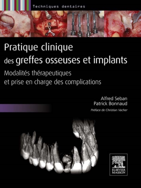 Pratique clinique des greffes osseuses et implants : Modalites therapeutiques et prise en charge des complications, EPUB eBook