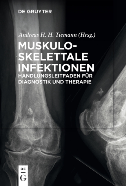 Muskuloskelettale Infektionen : Handlungsleitfaden fur Diagnostik und Therapie, PDF eBook
