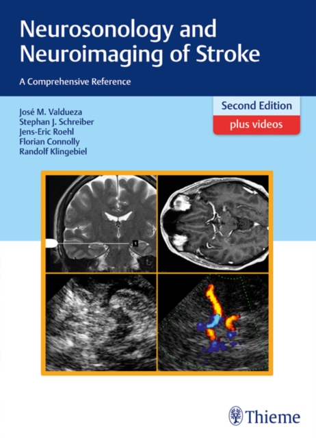 Neurosonology and Neuroimaging of Stroke : A Comprehensive Reference, EPUB eBook