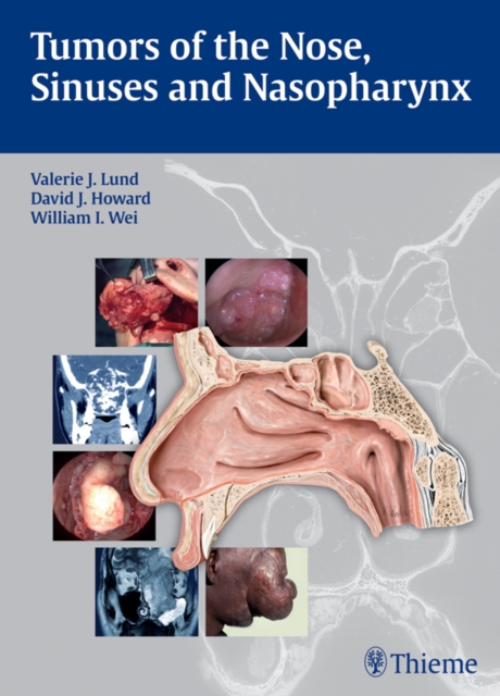 Tumors of the Nose, Sinuses and Nasopharynx, EPUB eBook