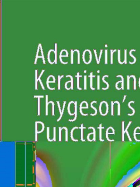 Adenovirus Epithelial Keratitis and Thygeson's Superficial Punctate Keratitis : In Vivo Morphology in the Human Cornea, PDF eBook
