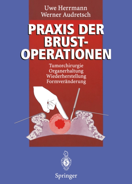 Praxis der Brustoperationen : Tumorchirurgie - Organerhaltung - Wiederherstellung - Formveranderung, PDF eBook