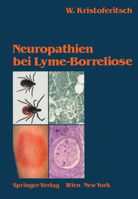Neuropathien bei Lyme-Borreliose, PDF eBook