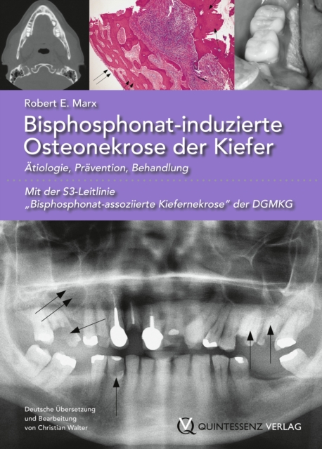 Bisphosphonat-induzierte Osteonekrose der Kiefer : Atiologie, Pravention, Behandlung, EPUB eBook