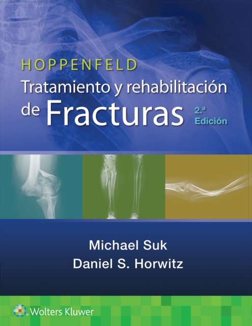 Hoppenfeld. Tratamiento y rehabilitacion de fracturas, Paperback / softback Book